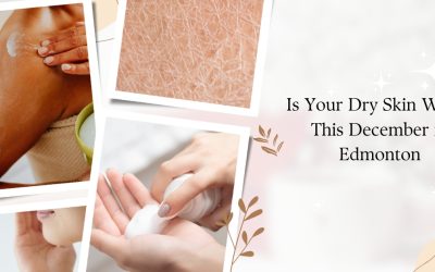 Is Your Dry Skin Worse This December in Edmonton
