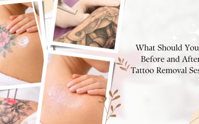 What Should You Do Before and After a Tattoo Removal Session